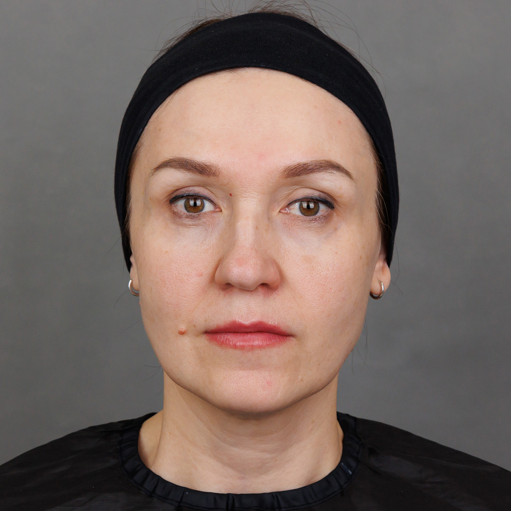 Микроигольчатая RF-терапия Morpheus 8 (InMode): фото после