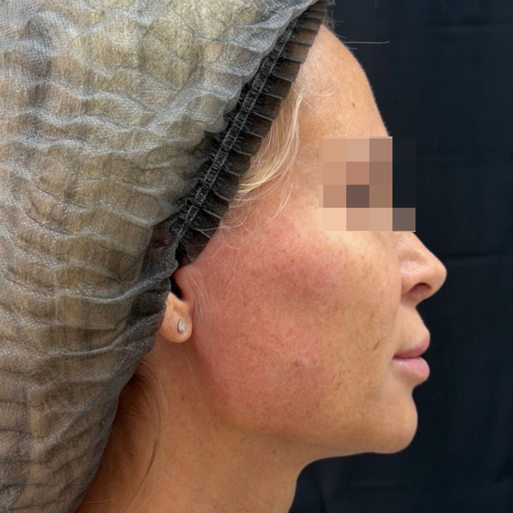 Oligio и Neauvia: фото после