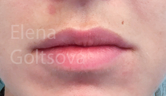 создание объема губ препаратом Belotero Balance, фото до процедуры