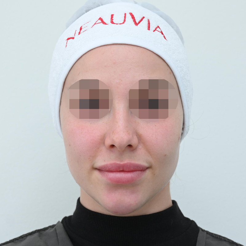 Процедура Fresh&Lift, фото до