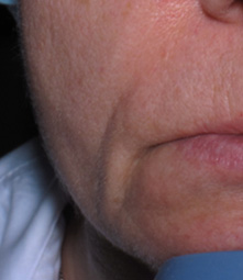 рельеф морщины