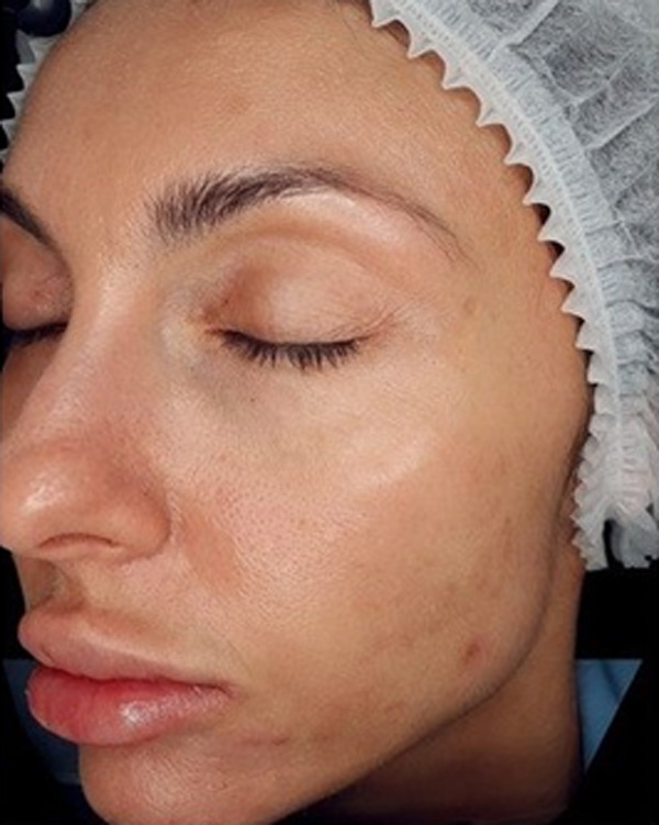 Calecim Professional Serum