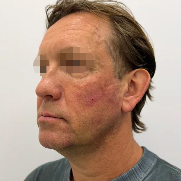 Neauvia Man, фото до и после