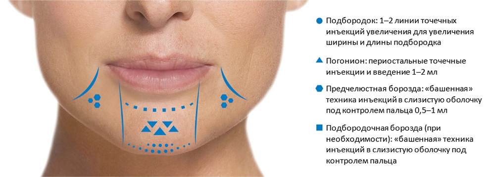 Точки проведения инъекций для формирования более острой формы и четкого контура подбородка