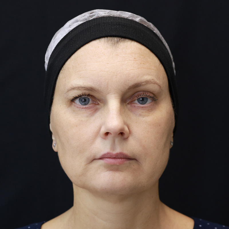 Bioregen Фото после