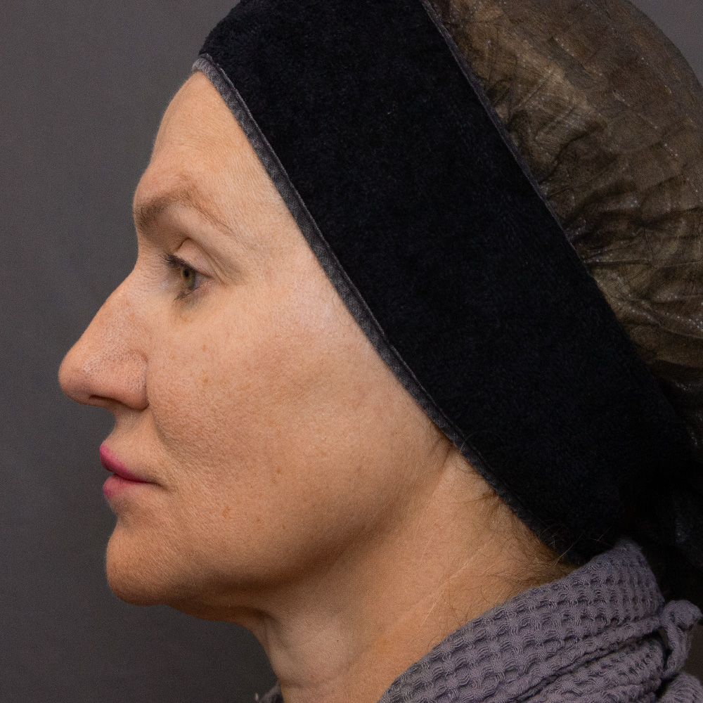 Протокол процедуры Peach Peel PRO и Colibriderm Hydro, фото после