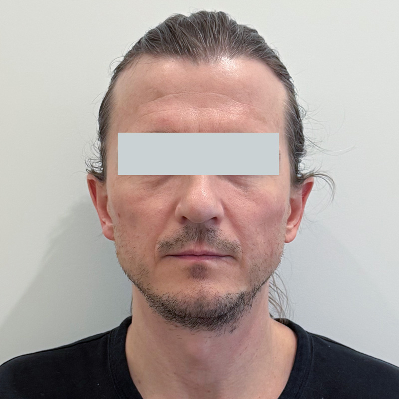 RF и HIFES на аппарате Emface