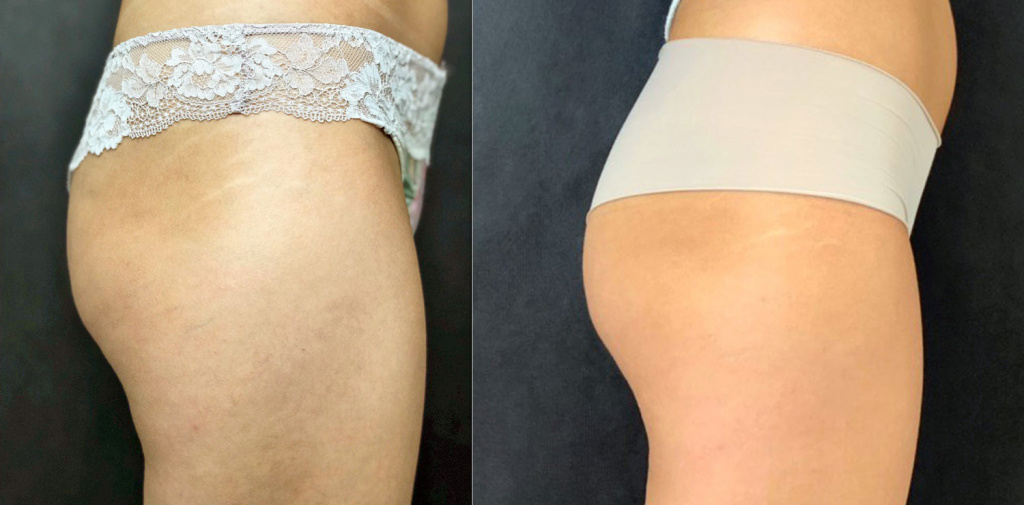 коррекция на аппарате Accent, фото до и после