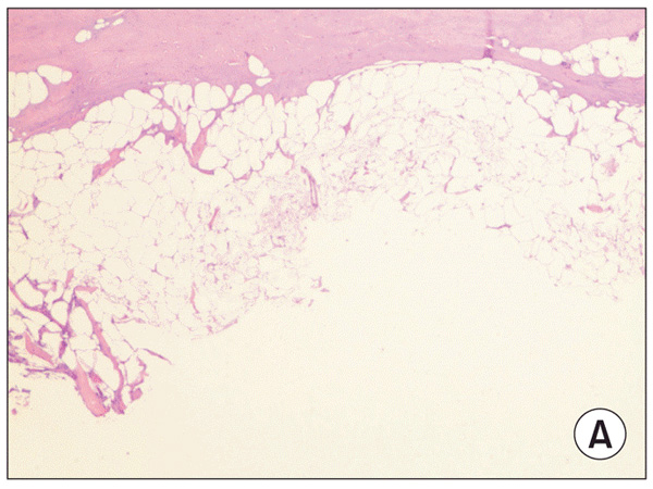 Гистопатологические данные в подкожно-жировом слое