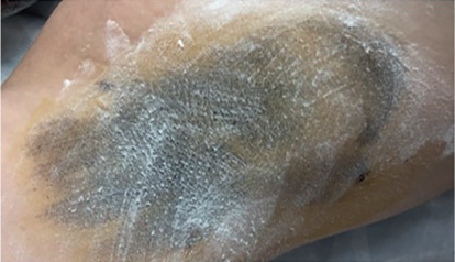 Тест Минора до процедуры