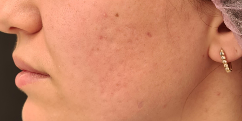 Комбинированная терапия акне