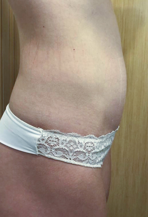 коррекция на аппарате Ultraformer, фото до