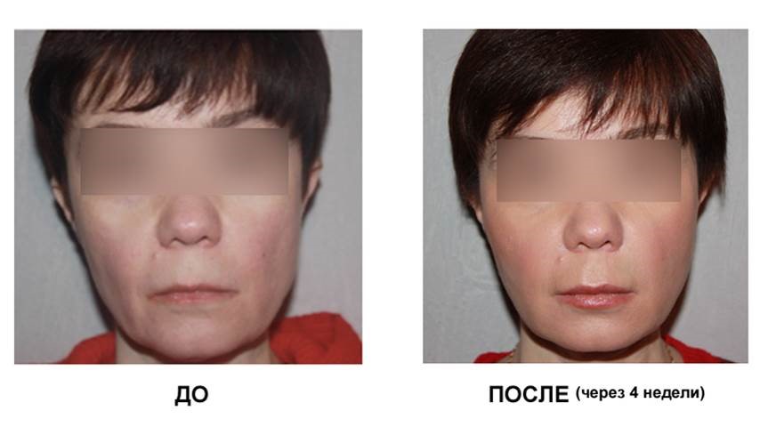 Фото до и после процедуры тредлифтинга