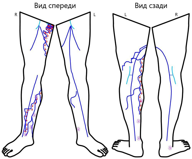 Карта вен нижних конечностей