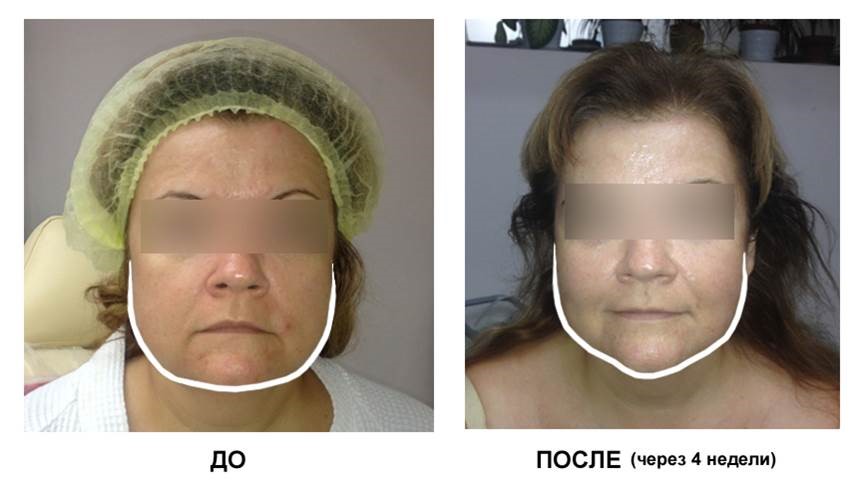 Фото до и после процедуры тредлифтинга