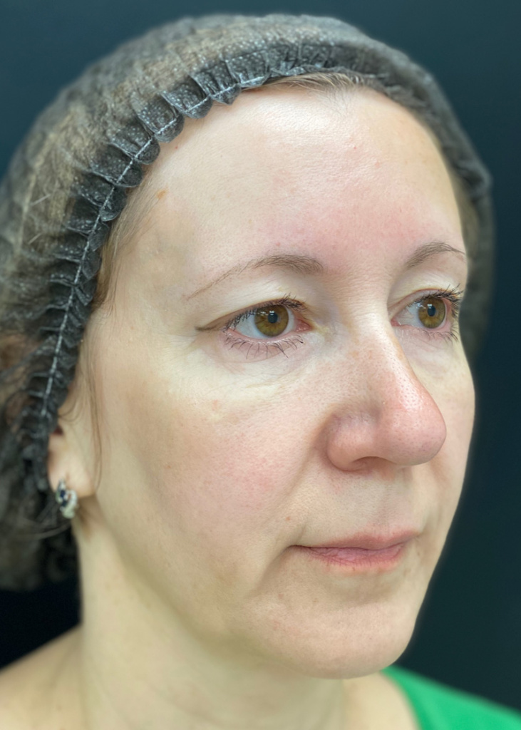 После проведения процедуры с препаратом MIRACOLL fille