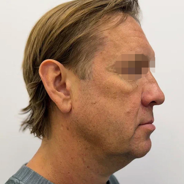 Neauvia Man, фото до и после