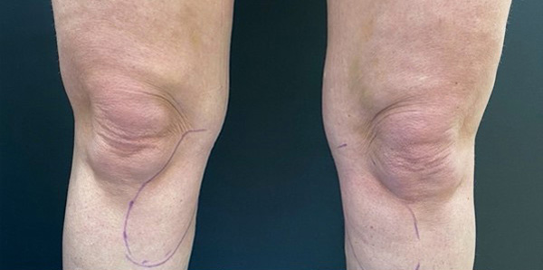 Скульптра плюс криолиполиз