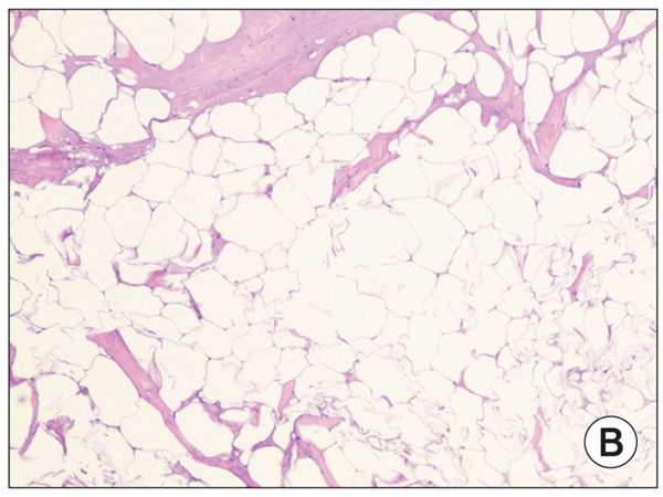 сморщенные адипоциты