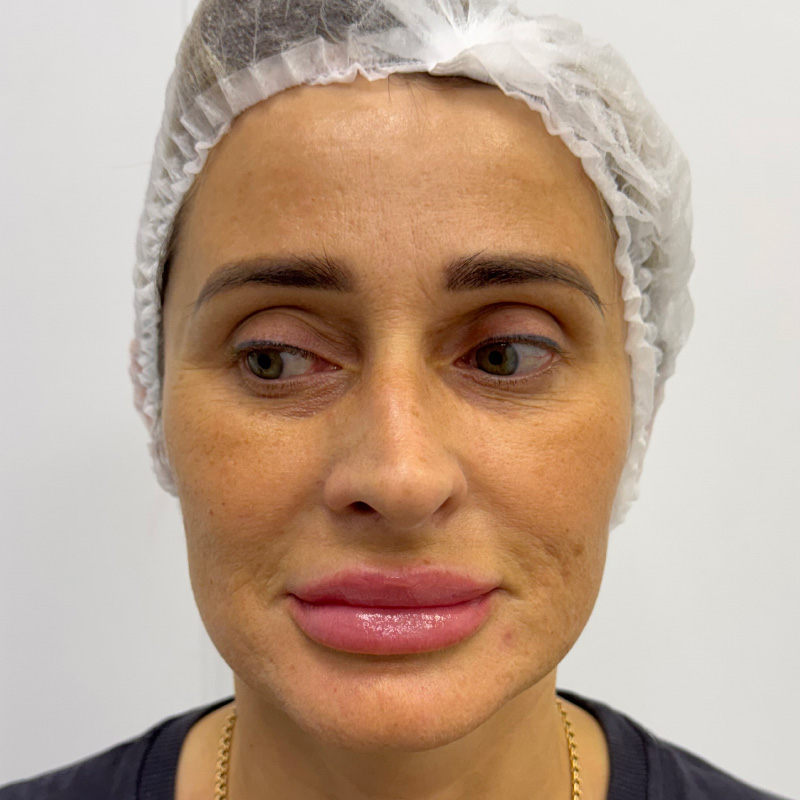 CO₂ лазер + Cellenis PRP, фото До