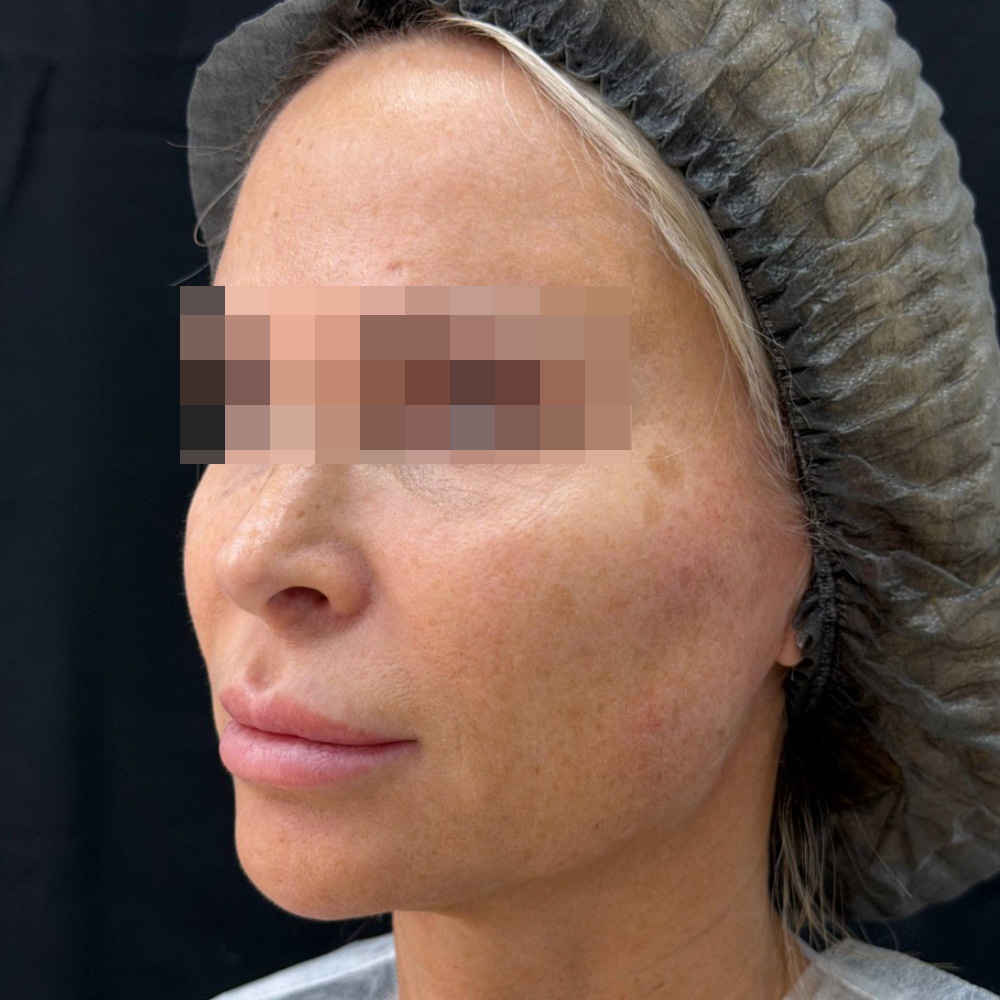 Oligio и Neauvia: фото после