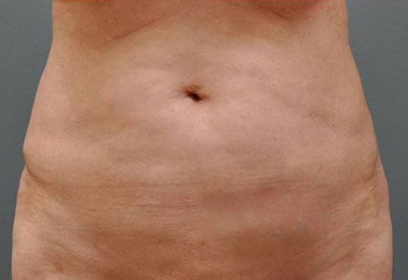 Ultherapy живот, фото после