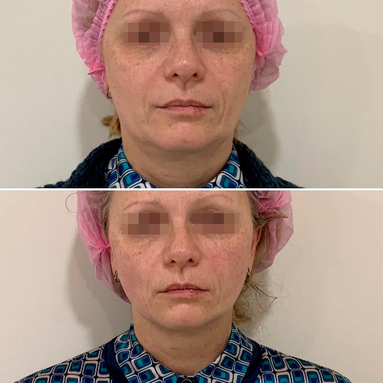 Результаты до/сразу после процедуры Doublo HIFU