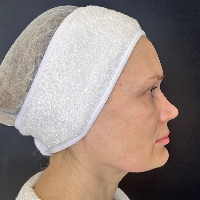 Протокол Bio-Mix Regenyal, фото после