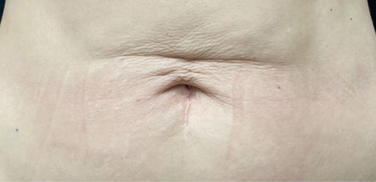 Скульптра плюс Thermage