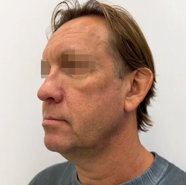 Neauvia Man, фото до и после