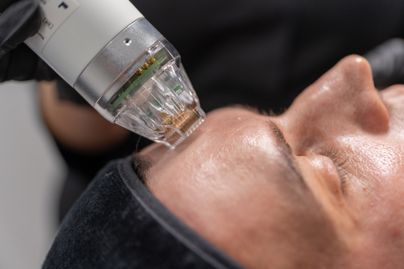 Комплексная стратегия против атрофических рубцов