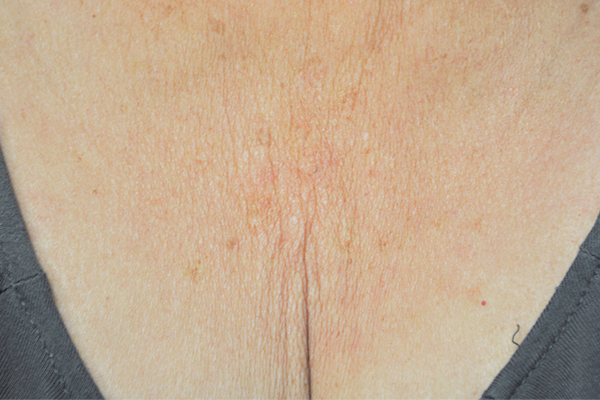 Зона декольте до процедуры на аппарате Exilis Ultra 360™