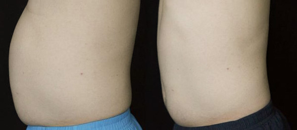 SLIMUS, фото до и после