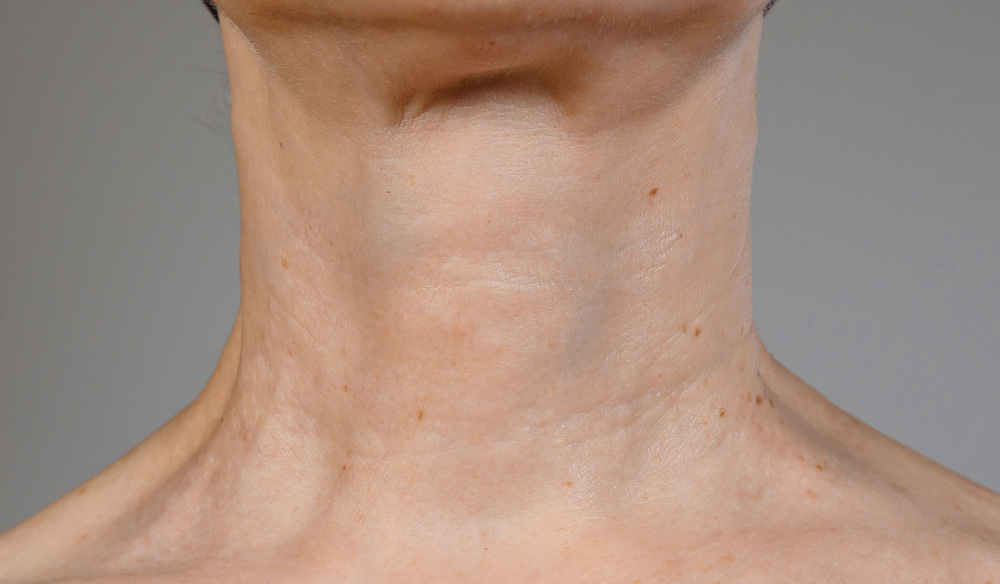 RRS® HA Long Lasting: шея после