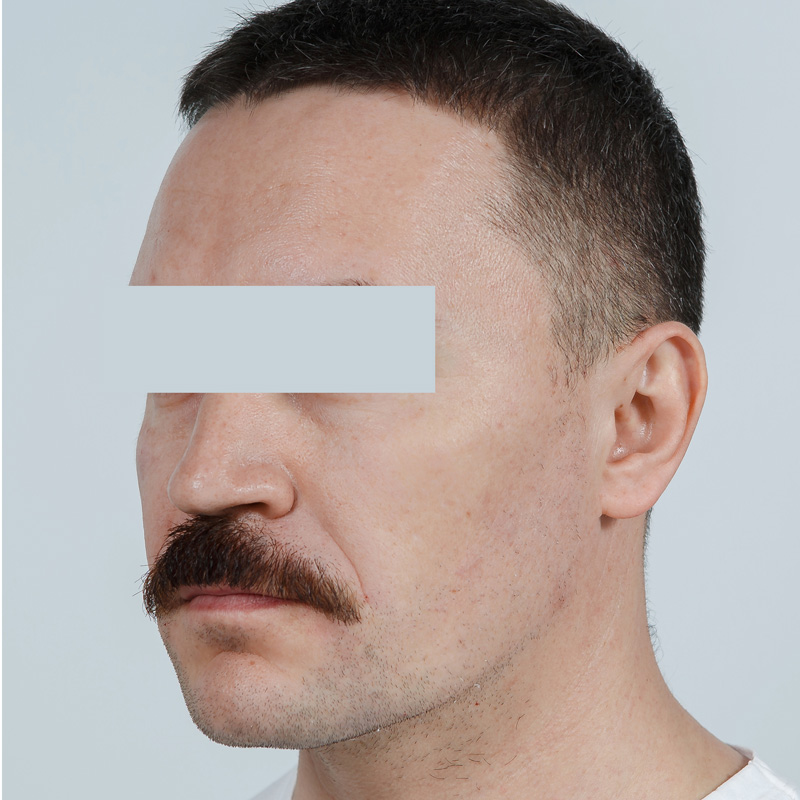 RRS® HA Long Lasting