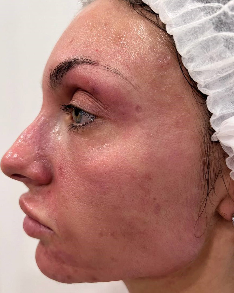 Calecim Professional Serum