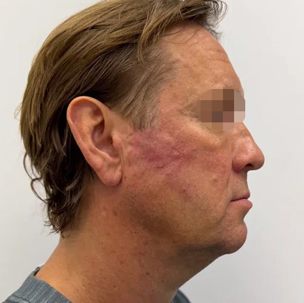 Neauvia Man, фото до и после