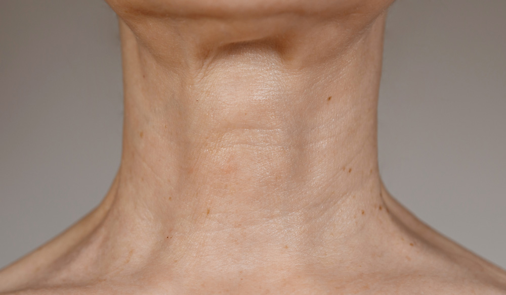 RRS® HA Long Lasting: шея до