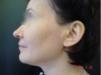 Лифтинг кожи и улучшение контуров субментальной области через 2 недели после начала курса (проведена 1 процедура). Лифтинг кожи и улучшение контуров субментальной области через 2 недели после начала курса (проведена 1 процедура).