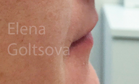 коррекции сложных тонких губ препаратом Belotero Intense, фото до процедуры