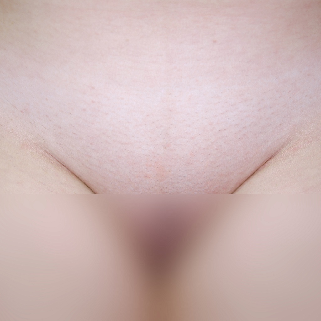 После эпиляции MOVEO