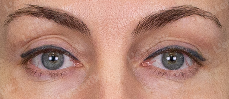 RF-лифтинг Ashley, фото После