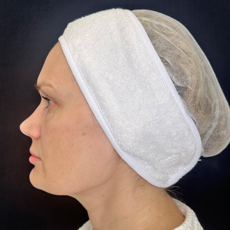 Протокол Bio-Mix Regenyal, фото после