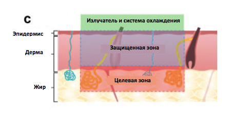 лечение гипергидроза на аппарате MiraDry