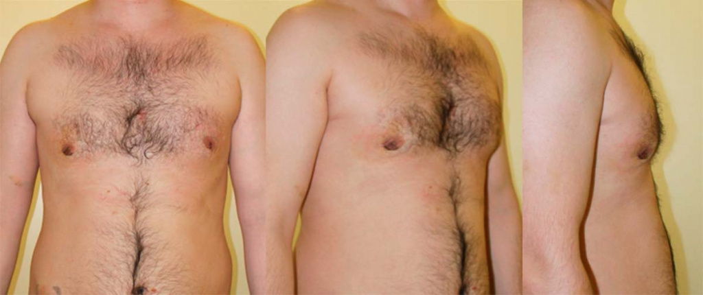 Фото после процедуры DEKA SmartLipo posle_mastektomii_DEKA-SmartLipo