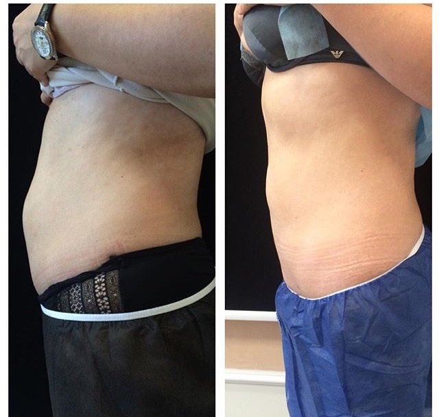 Фото жировые отложения до и после Liposonix