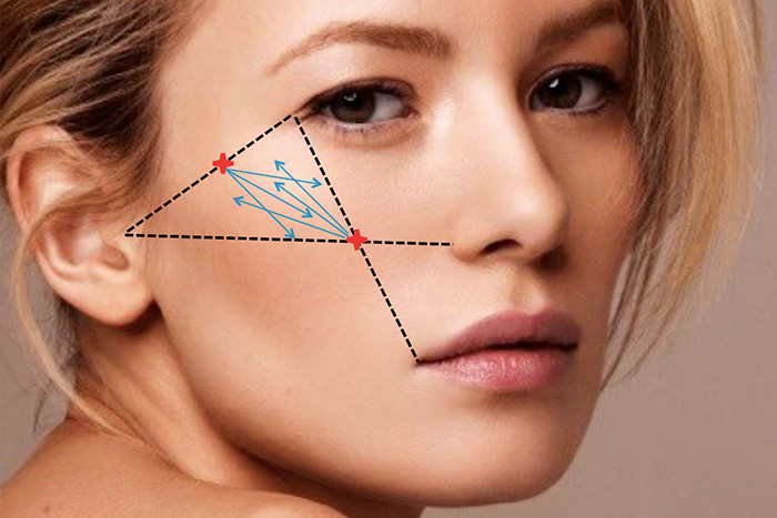 скуловая область, разметка, Restylane Perlane