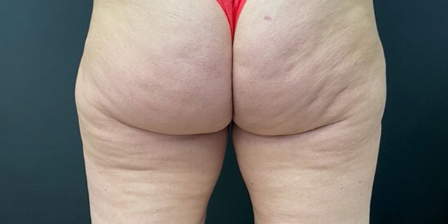 Скульптра, криолиполиз, EMSCULPT