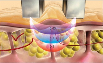 Глубина воздействия радиоволновой энергии различной частоты (МГц). Глубина воздействия радиоволновой энергии различной частоты (МГц).