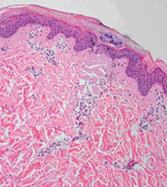 фракционный фототермолиз